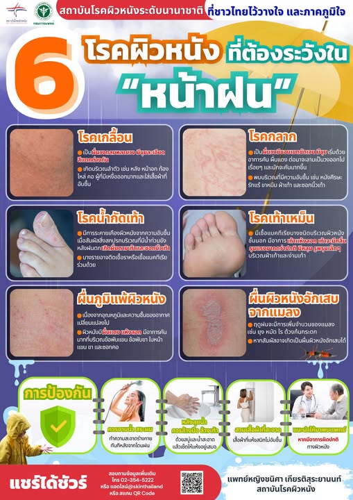 กรมการแพทย์เตือนเฝ้าระวัง 6 โรคผิวหนังช่วงหน้าฝนและน้ำท่วม